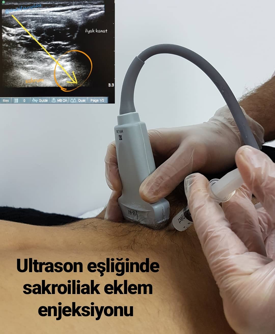 Ultrason Rehberliğinde Bölgesel Enjeksiyon Uygulamaları
