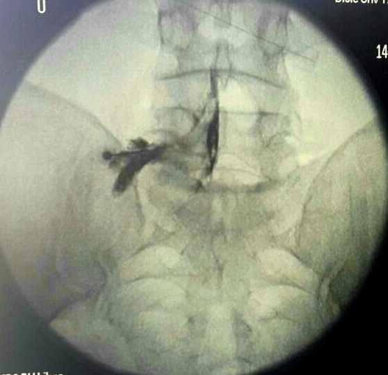 Bel Fıtığının Ameliyatsız Tedavi Yöntemleri: Transforaminal / Kaudal Epidural Enjeksiyon